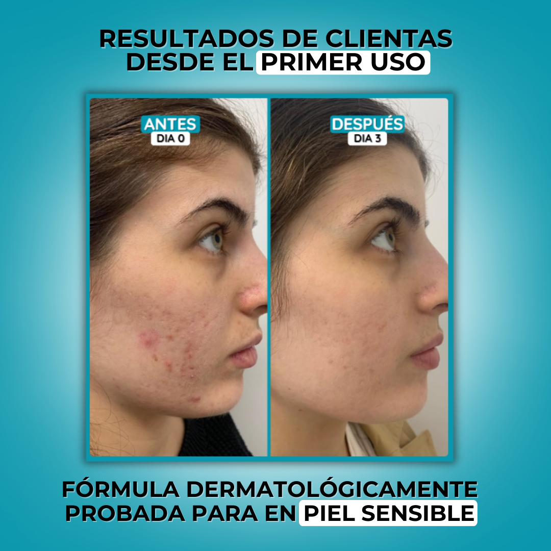 2X1 TRATAMIENTO ACNÉ (10 UNIDADES) + HIALURÓNICO