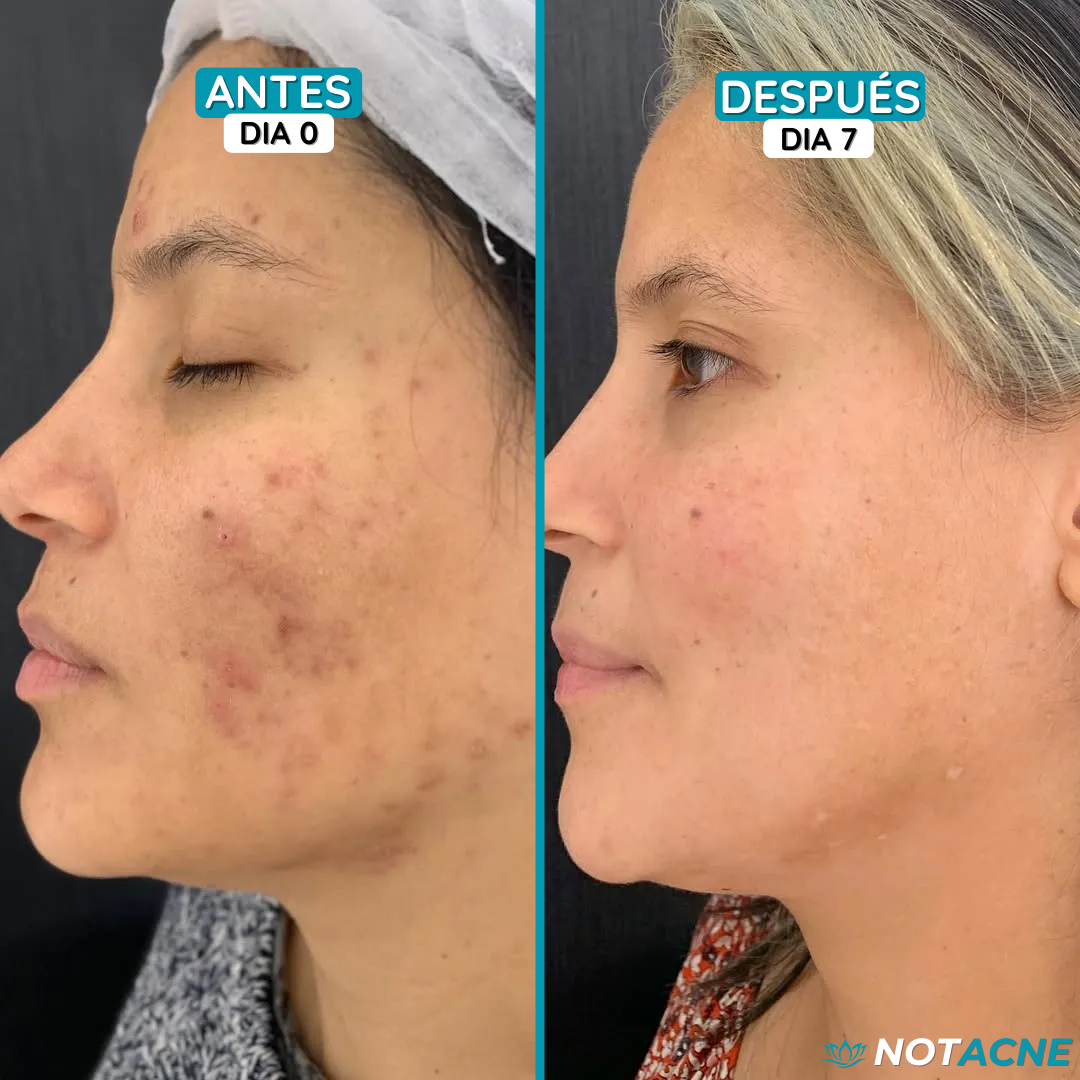 2X1 TRATAMIENTO ACNÉ (10 UNIDADES) + HIALURÓNICO