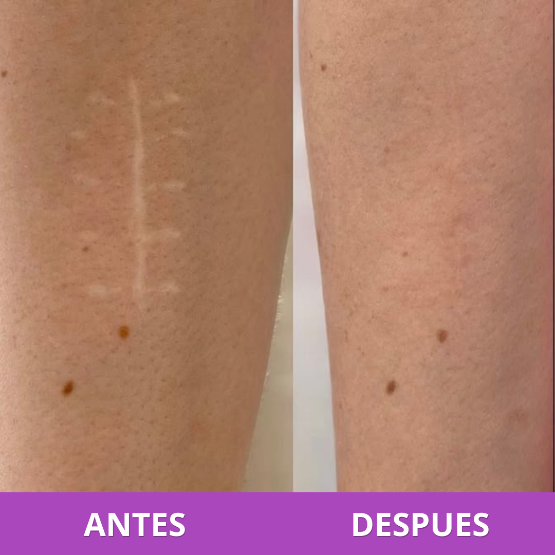 Parches para Cicatrices | Reduce y Aplana Marcas Visibles (Lleva 3 Paga 1)