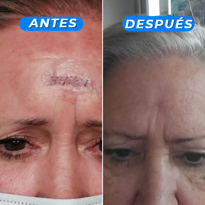 Parches para Cicatrices | Reduce Marcas Visibles en Semanas
