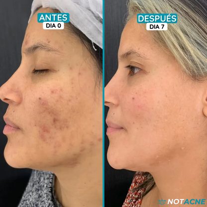 2X1 TRATAMIENTO ACNÉ (10 UNIDADES) + HIALURÓNICO