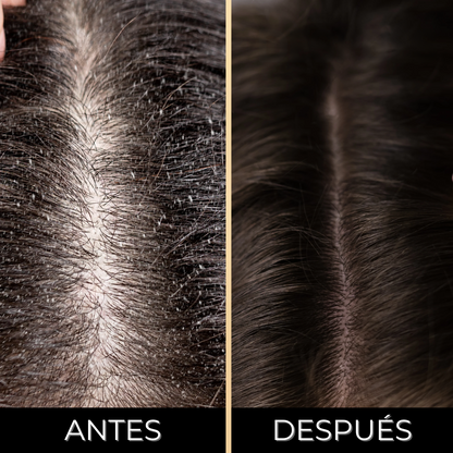 DOLCE HAIR™ | CREMA ANTI CASPA Y PICAZÓN