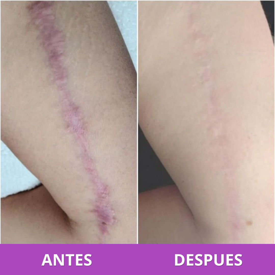 Parches para Cicatrices | Reduce y Aplana Marcas Visibles (Lleva 3 Paga 1)