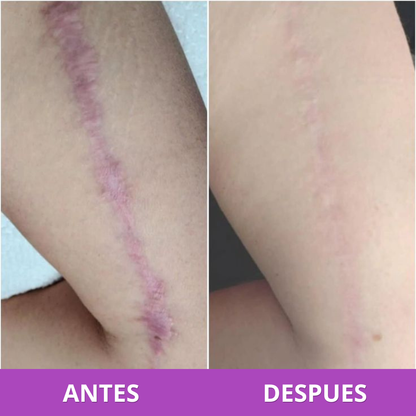 Parches para Cicatrices | Reduce y Aplana Marcas Visibles (Lleva 3 Paga 1)