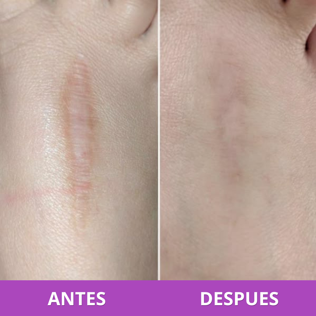 Parches para Cicatrices | Reduce y Aplana Marcas Visibles (Lleva 3 Paga 1)