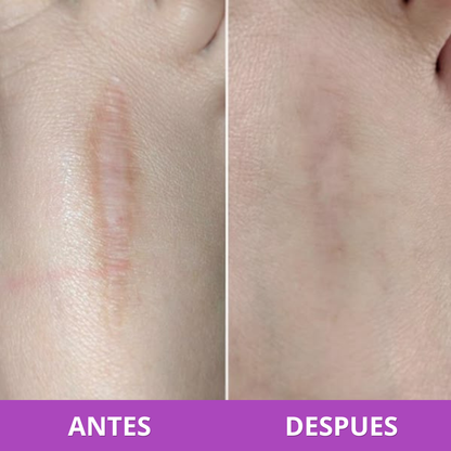 Parches para Cicatrices | Reduce y Aplana Marcas Visibles (Lleva 3 Paga 1)