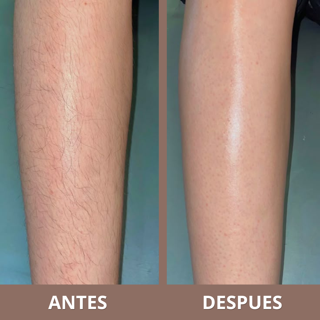 Aceite Inhibidor de Vello | Frena el Crecimiento del Vello Corporal (Lleva 2 Paga 1)