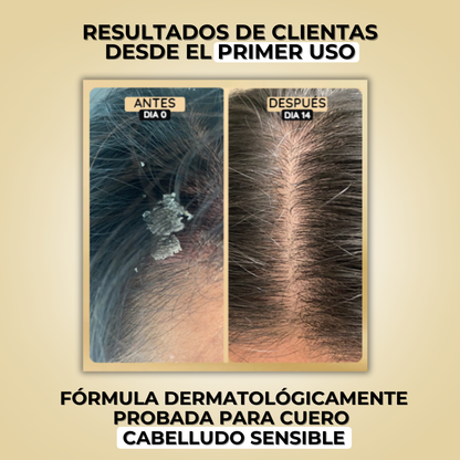 DOLCE HAIR™ | CREMA ANTI CASPA Y PICAZÓN