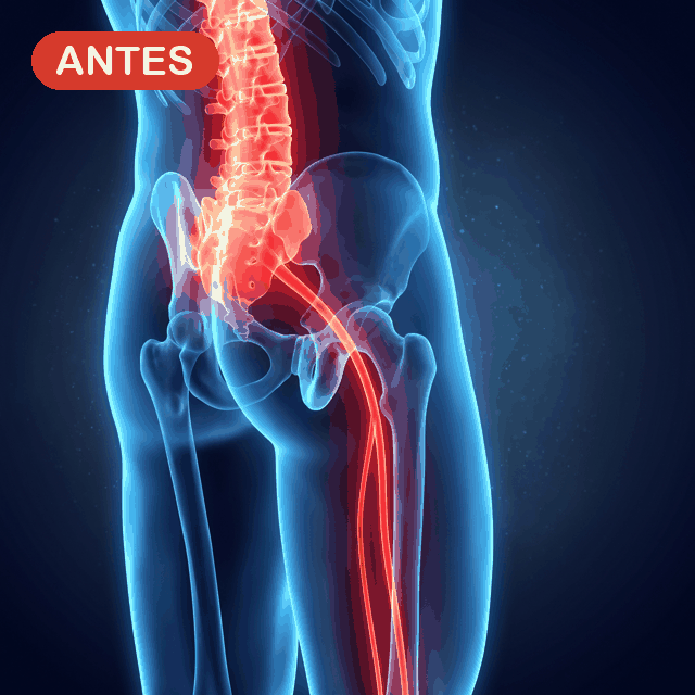 Cinturon ciatica antes y despues - dolor lumbar y nervio aliviado con soporte